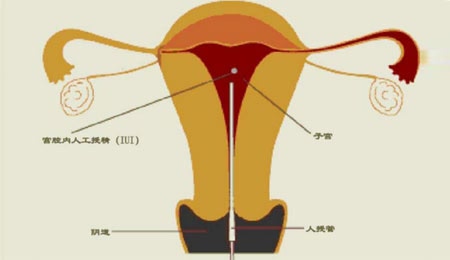 打胎
