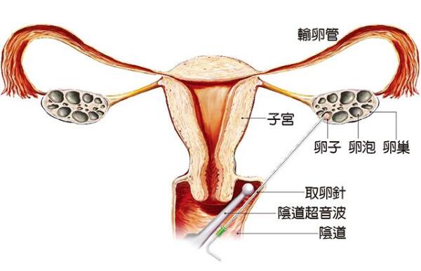 女人打胎